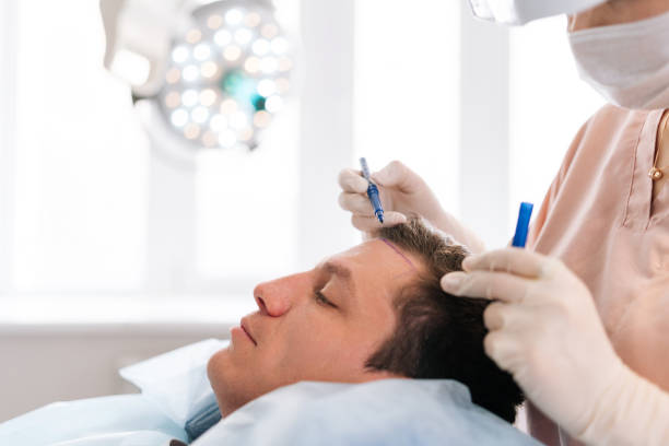 a greffe de cheveux peut être réalisée selon deux techniques : FUE ou FUT. D’abord, la FUE (Follicular Unit Extraction) consiste à prélever