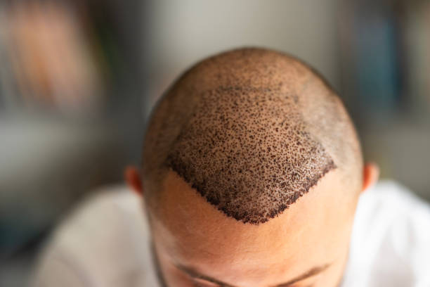 La méthode FUT signifie Follicular Unit Transplantation. Elle fait partie des techniques classiques en GREFFE DE CHEVEUX. En premier lieu,