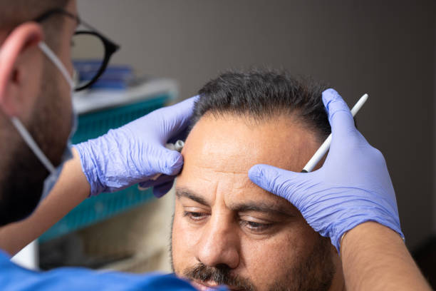 La GREFFE DE CHEVEUX par FUT (Follicular Unit Transplantation) est une méthode populaire. En effet, elle permet de restaurer