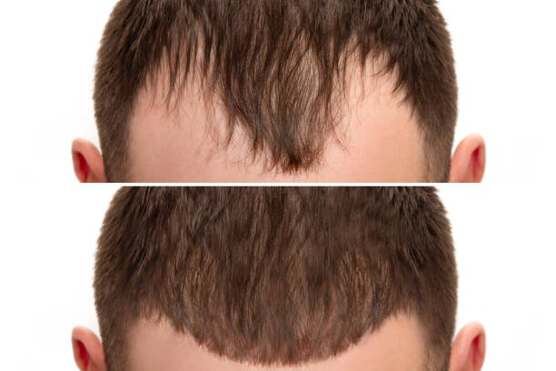 La GREFFE DE CHEVEUX par FUT est une intervention chirurgicale minutieuse. En effet, elle exige une grande précision.