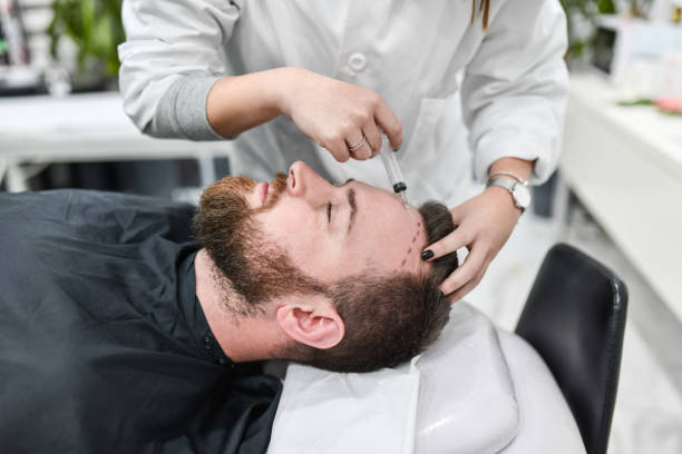 Avant tout, la GREFFE DE CHEVEUX vise à corriger une perte capillaire visible. En effet, deux techniques dominent ce domaine