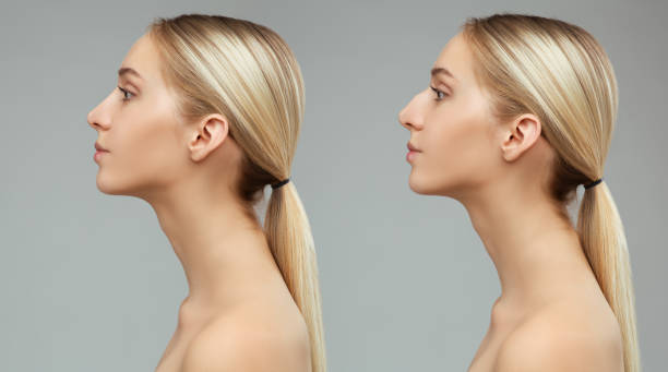 Les chirurgiens esthétiques associent souvent rhinoplastie et génioplastie pour harmoniser le profil. En effet, ces deux opérations