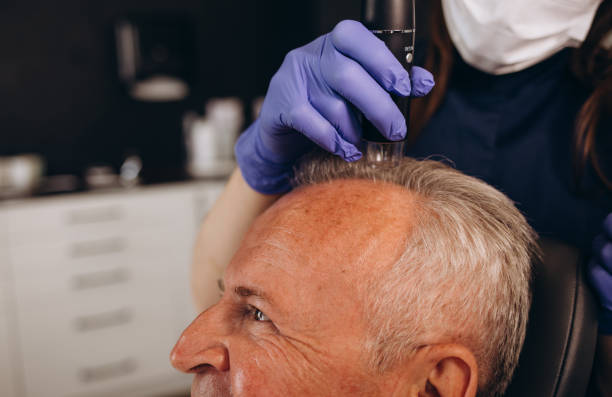 Juste après une greffe de cheveux, les signes de l’intervention sont clairement visibles. En effet, le cuir chevelu présente souvent
