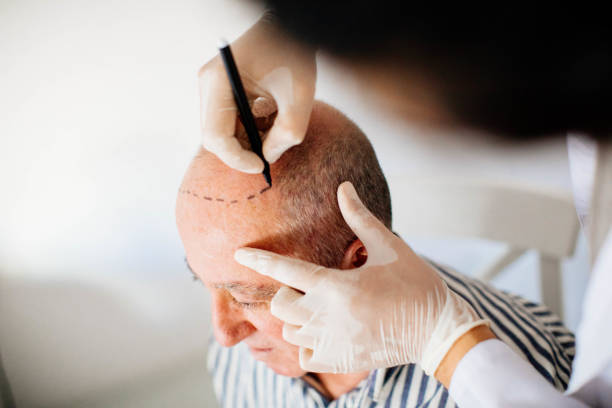 La greffe de cheveux est une intervention chirurgicale précise. En effet, elle consiste à prélever des follicules capillaires