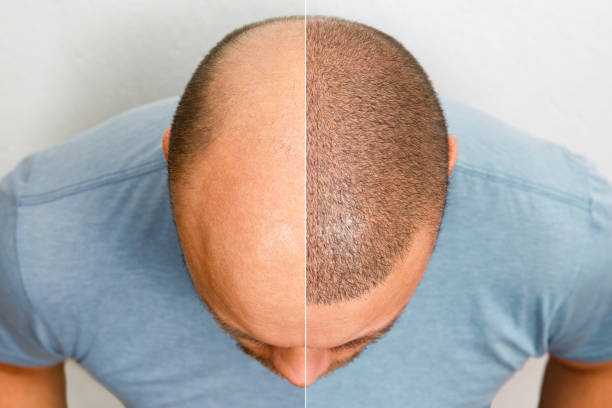 Après une greffe de cheveux, il est fréquent d'observer une chute temporaire. En effet, cela s'appelle le « shock loss ».