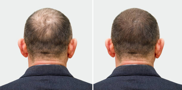 La greffe de cheveux débute par une réaction naturelle du corps. En effet, juste après l’intervention, une phase inflammatoire apparaît.